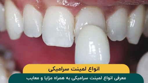 مزایای-لمینت-سرامیکی